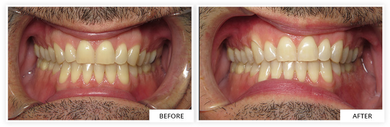 Ali Before and After