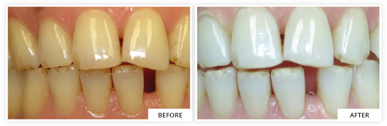 Bleaching Before and After