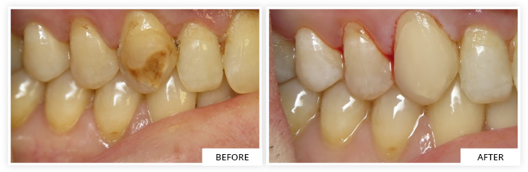 Bonding Before and After