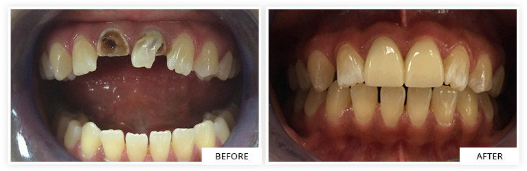 Dental Before and After
