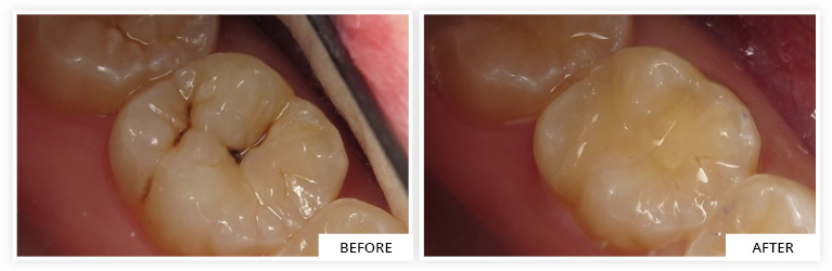 Composite Before and After