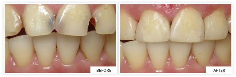 Composite Before and After