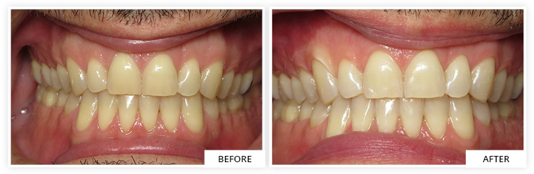 Bleaching Before and After