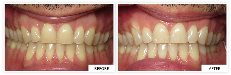 Bleaching Before and After