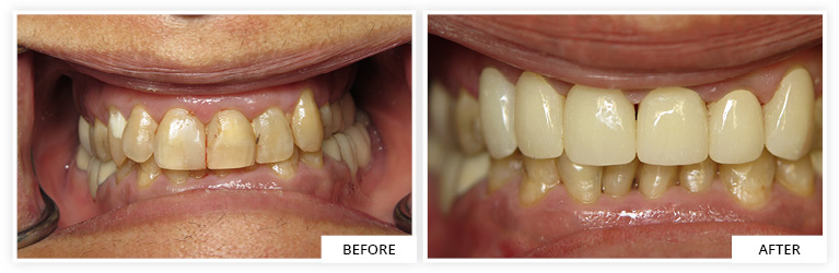 Crowns Before and After