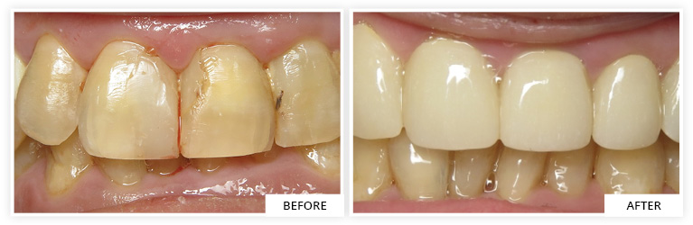 Crowns Before and After