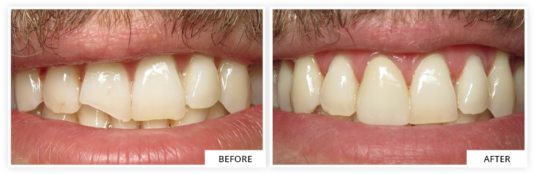 dental crown zirconium silver spring maryland