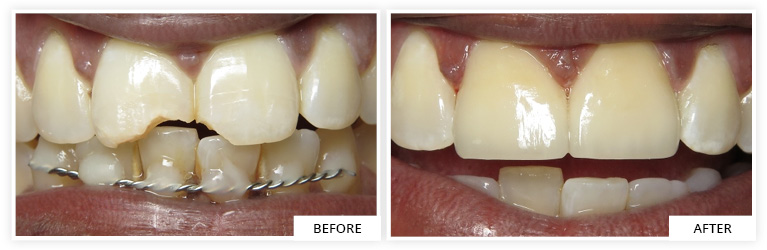 Crowns and Veneers Before and After