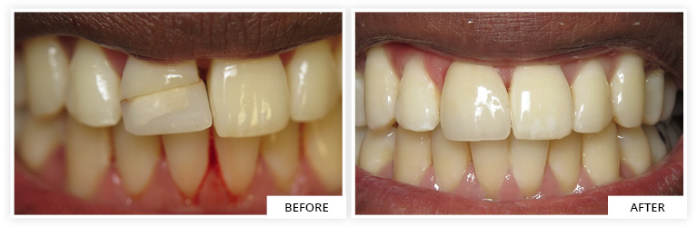 Crowns Before and After