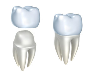 dental-crown-dentist-silver-spring-md