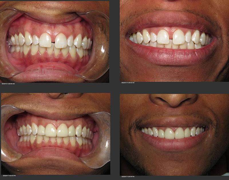 Desmond Before and After