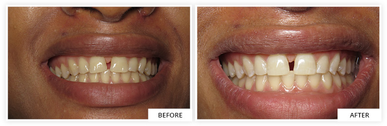 teeth bleaching whitening dentist silver spring maryland