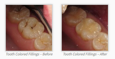 fillings-before-after