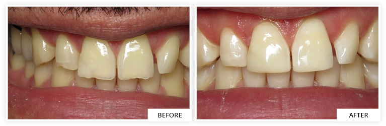 Composite Before and After