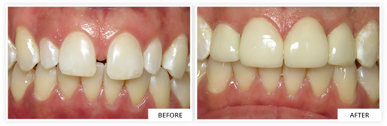 I and V Before and After