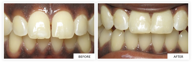 clear aligner dentist silver spring maryland