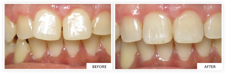 Invisalign dental clinic silver spring maryland