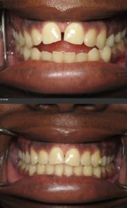 invisalign dentist silver spring maryland