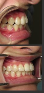 invisalign dentist silver spring maryland