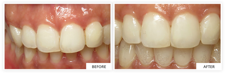 Invisalign dental clinic silver spring maryland