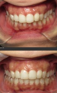 invisalign dentist silver spring maryland