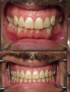 invisalign dentist silver spring