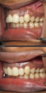 clear aligners dentist silver spring dentist