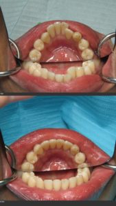 dentist invisalign silver spring