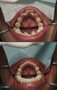 invisalign dentist silver spring