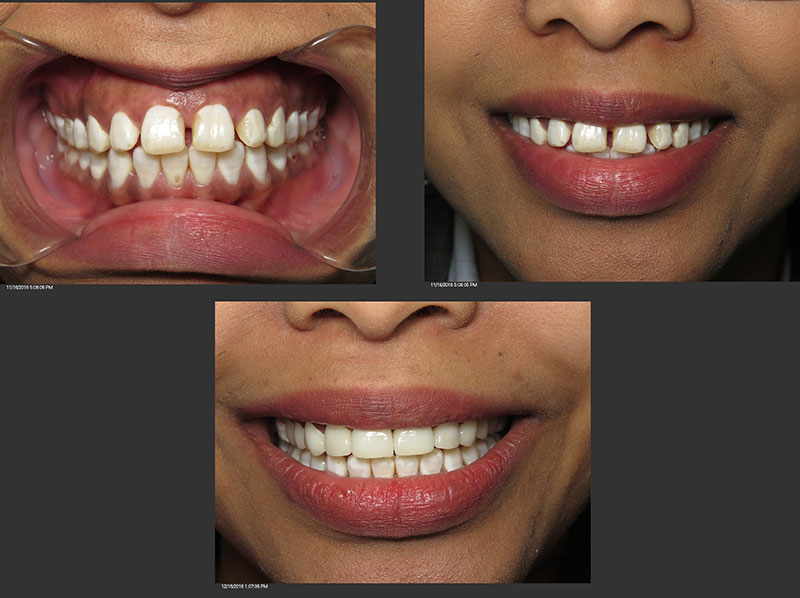 dental porcelain veneer dentist silver spring Maryland