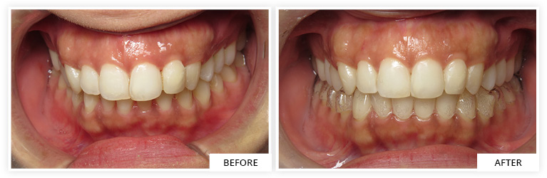 Invisalign dental clinic silver spring maryland