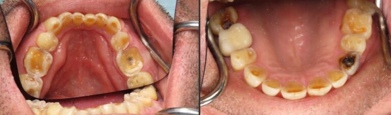 teeth grinding silver spring