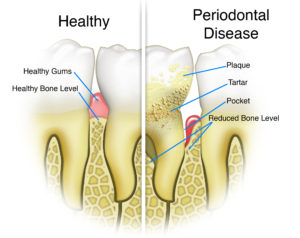 periodontal-disease