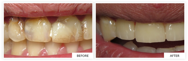 dental crown front teeth dentist silver spring maryland