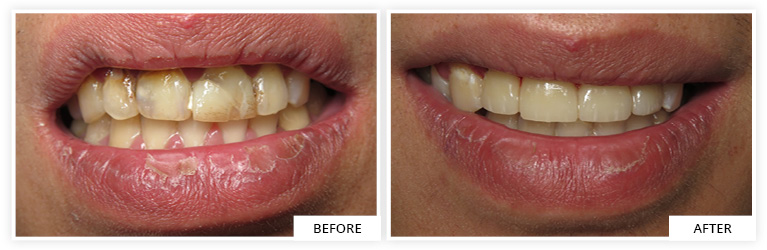 dental crown front teeth dentist silver spring maryland