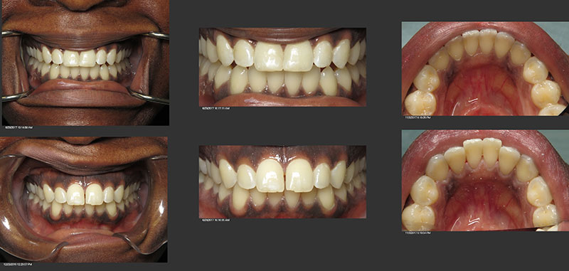 Invisalign dentistry office silver spring Maryland