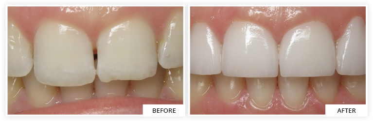 Veneers Before and After dentist silver spring maryland