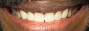 Veneers – After