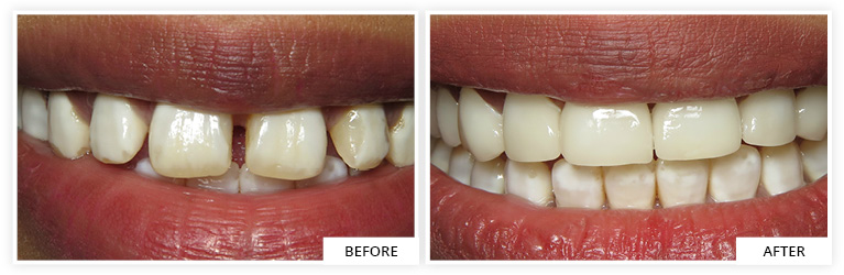 Veneers Before and After