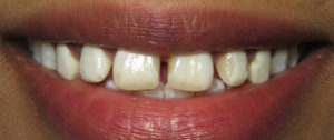 Veneers – Before