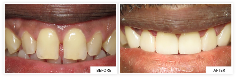 Veneers Before and After dentist silver spring maryland