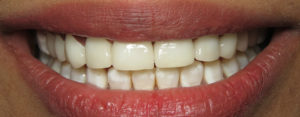 Veneers – After