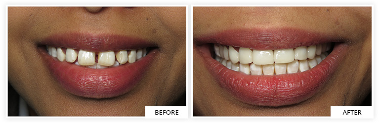 dental veneers dentist silver spring maryland