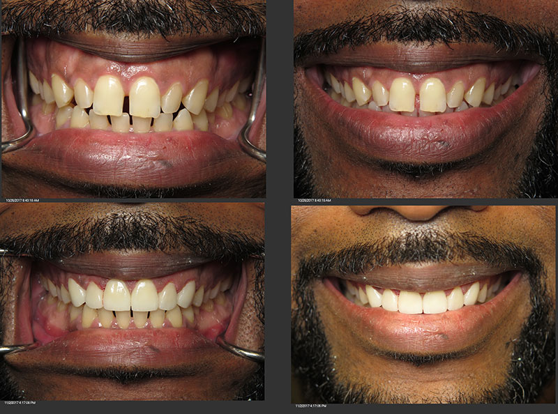 dental veneers clinic near me silver spring Maryland