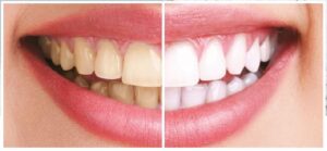 zoom-teeth-whitening